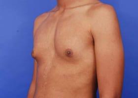 Gynecomastia Surgery Before & After Image