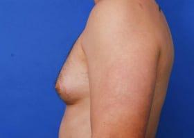 Gynecomastia Surgery Before & After Image