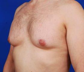 Gynecomastia Surgery Before & After Image