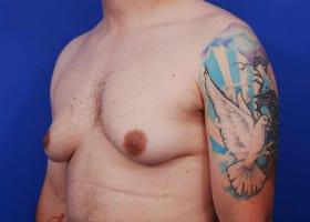 Gynecomastia Surgery Before & After Image