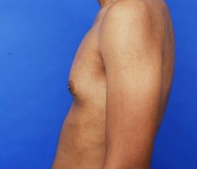 Gynecomastia Surgery Before & After Image