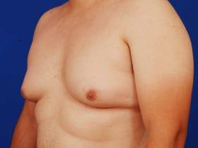 Gynecomastia Surgery Before & After Image