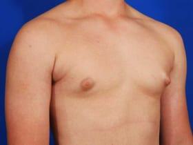 Gynecomastia Surgery Before & After Image
