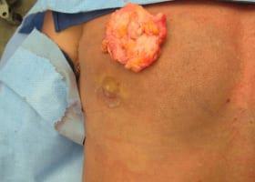 Gynecomastia Surgery Before & After Image