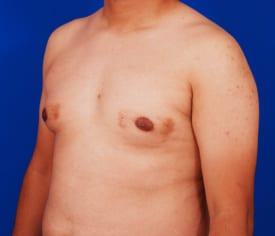 Gynecomastia Surgery Before & After Image