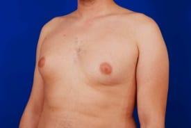 Gynecomastia Surgery Before & After Image