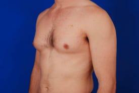 Gynecomastia Surgery Before & After Image