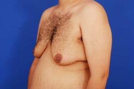 Gynecomastia Surgery Before & After Image