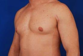 Gynecomastia Surgery Before & After Image