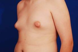 Gynecomastia Surgery Before & After Image