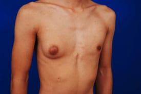 Gynecomastia Surgery Before & After Image