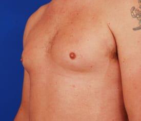 Gynecomastia Surgery Before & After Image
