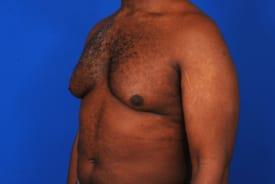 Gynecomastia Surgery Before & After Image