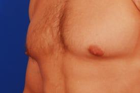 Gynecomastia Surgery Before & After Image