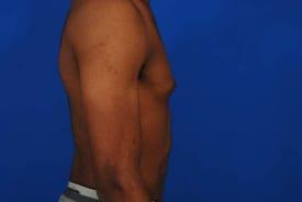 Gynecomastia Surgery Before & After Image