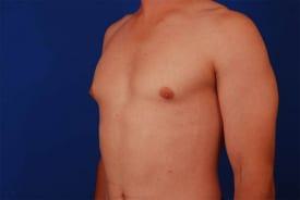 Gynecomastia Surgery Before & After Image