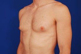Gynecomastia Surgery Before & After Image