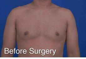 Gynecomastia Surgery Before & After Image