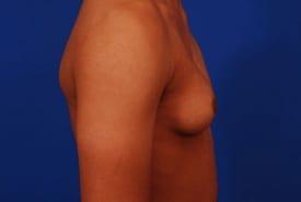 Gynecomastia Surgery Before & After Image