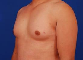 Gynecomastia Surgery Before & After Image