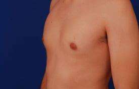Gynecomastia Surgery Before & After Image
