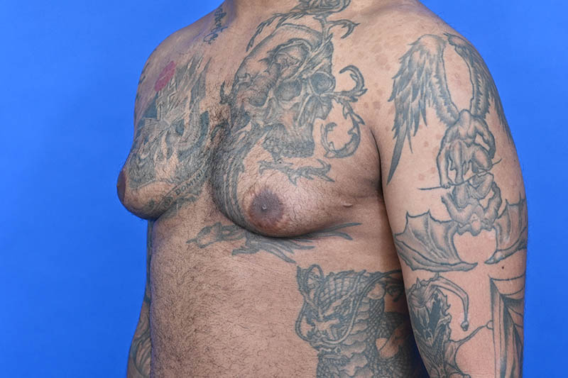 Revision Gynecomastia Surgery Before & After Image