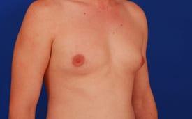Gynecomastia Surgery Before & After Image