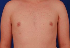 Gynecomastia Surgery Before & After Image