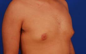 Gynecomastia Surgery Before & After Image