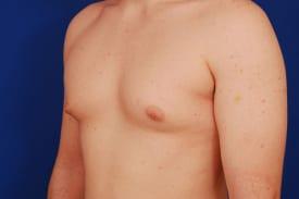 Gynecomastia Surgery Before & After Image