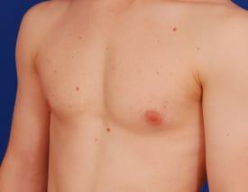 Gynecomastia Surgery Before & After Image