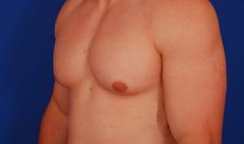 Gynecomastia Surgery Before & After Image