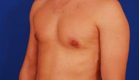 Gynecomastia Surgery Before & After Image