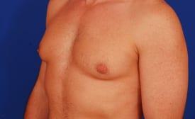 Gynecomastia Surgery Before & After Image