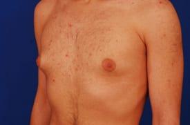 Gynecomastia Surgery Before & After Image