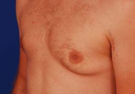 Gynecomastia Surgery Before & After Image