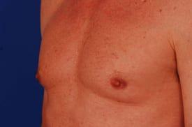 Gynecomastia Surgery Before & After Image