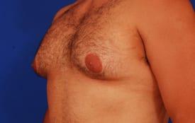 Gynecomastia Surgery Before & After Image