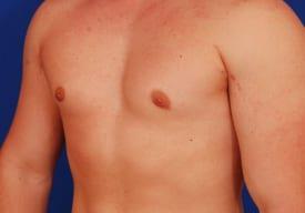 Gynecomastia Surgery Before & After Image