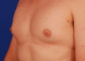 Gynecomastia Surgery Before & After Image