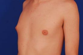 Gynecomastia Surgery Before & After Image