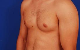 Gynecomastia Surgery Before & After Image