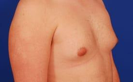 Gynecomastia Surgery Before & After Image