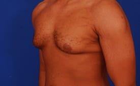 Gynecomastia Surgery Before & After Image