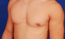 Gynecomastia Surgery Before & After Image
