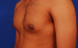 Gynecomastia Surgery Before & After Image