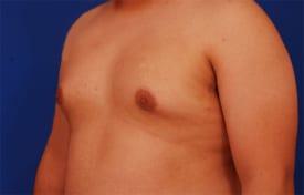 Gynecomastia Surgery Before & After Image