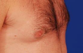 Gynecomastia Surgery Before & After Image