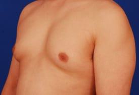 Gynecomastia Surgery Before & After Image