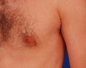 Gynecomastia Surgery Before & After Image